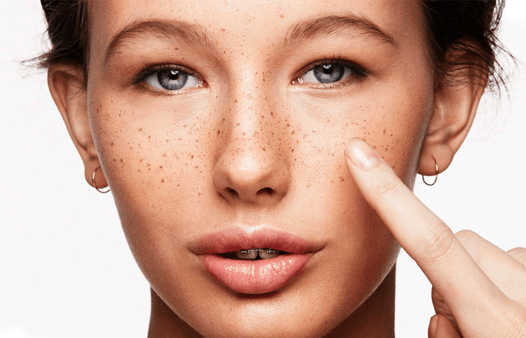 hiperpigmentaciya-starcheski-petna