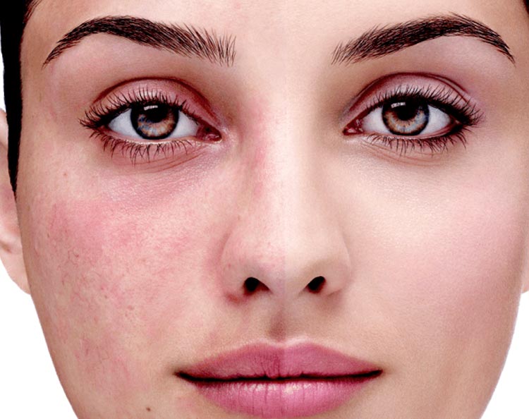 rozaceya-vidove-prichini-i-lechenie