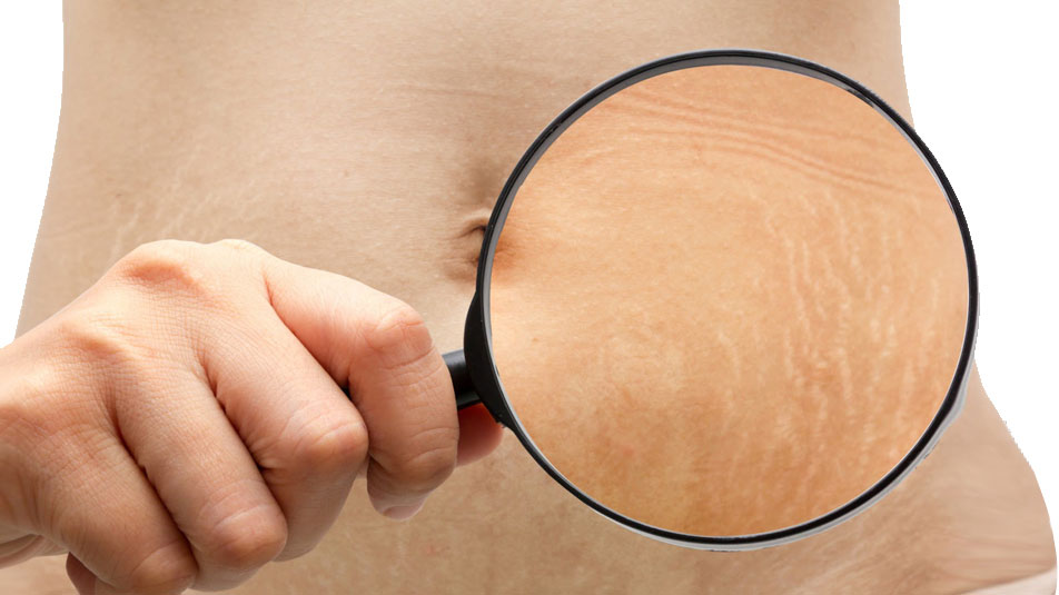 mikronidling-lazerni-proceduri-i-drugi-nehirurgichni-resheniya-za-strii