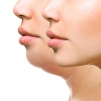 liposukciya-dvoyna-bradichka