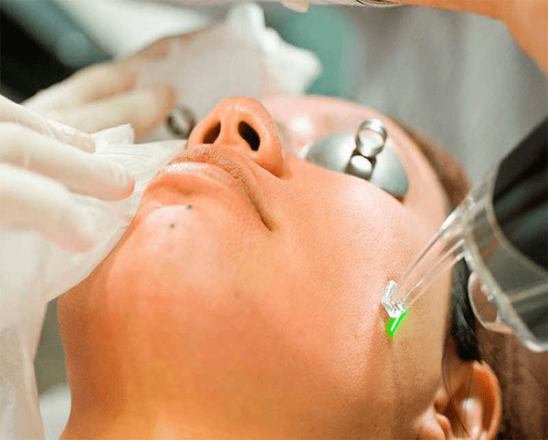 lazer-vagleroden-dioksid-lice