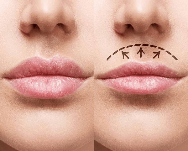 lifting-na-ustni-ili-liplift