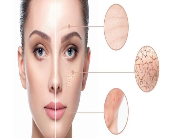 lazeren-piling-lazeren-resarfising